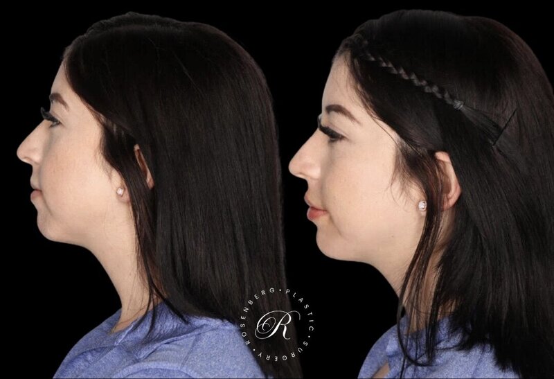 Non-surgical Lip Augmentation RPS Before & Afters.zip - 23