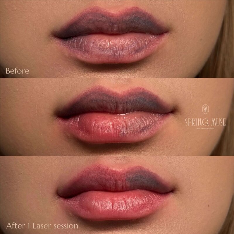Laser Lip Blush Removal New York