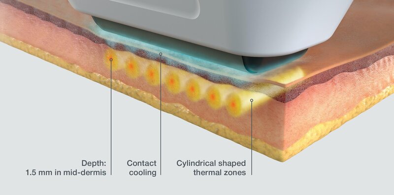 Illustration of hoe Skinwave works deep in your skin for precise, lasting results.