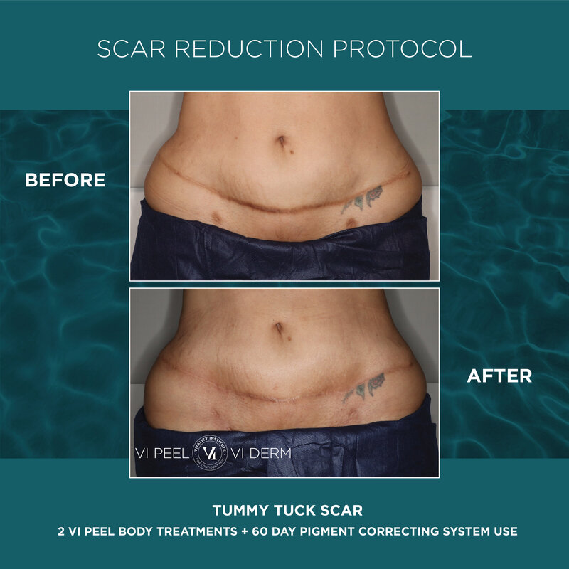 1 ScarReductionProtocol_TummyTuck_2Peel60 Day_GRAPHIC (2)