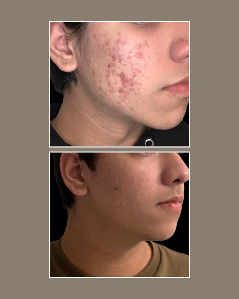 rosacea and acne - Skin Concerns - Glösense Dermatology and Aesthetics, Miami