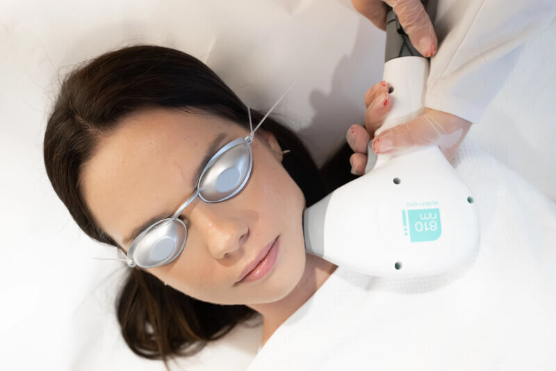 Laser hair removal