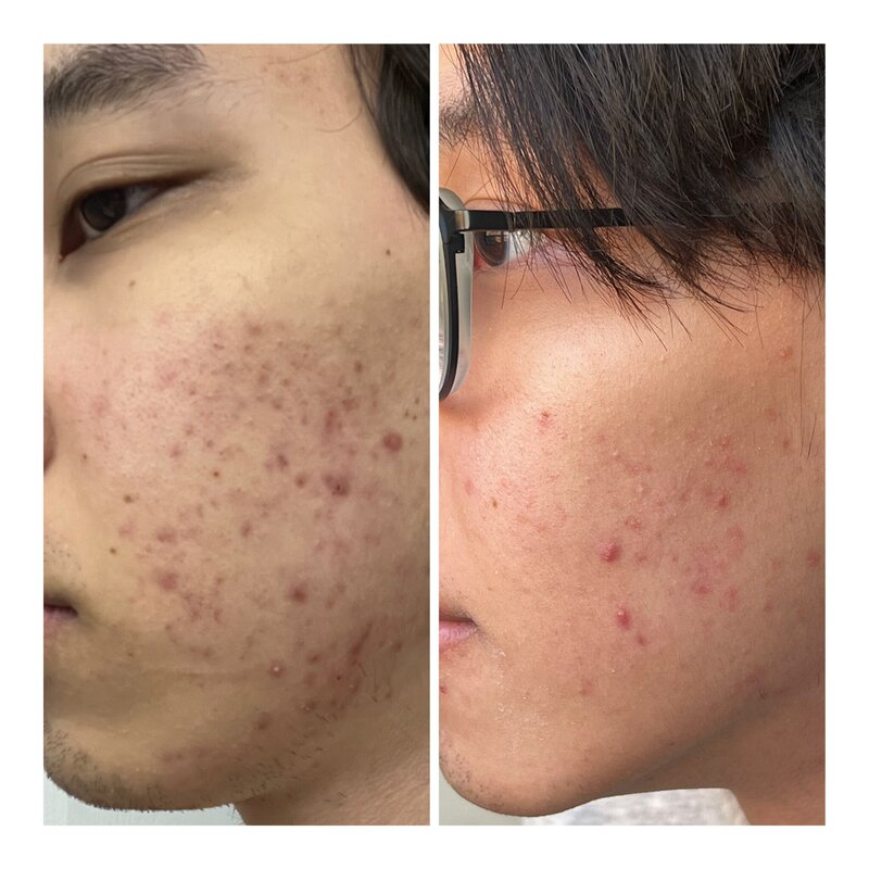 Before and after photos of acne treatment with a chemical peel in Charleston