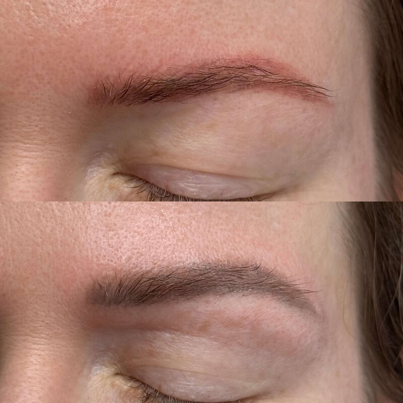 Permanent makeup removal