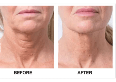 Profhilo-before-and-after-neck-to-go-on-main-page.-Keywords-for-saggy-neck-ageing-neck-loose-skin-on-neck-etc-400x284
