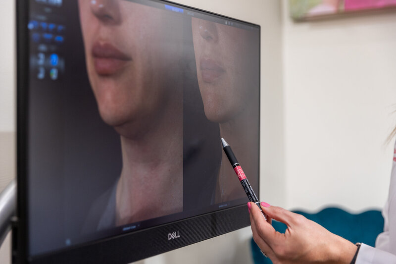 A client undergoing a chemical peel at Rose Injectables in Canon City, CO