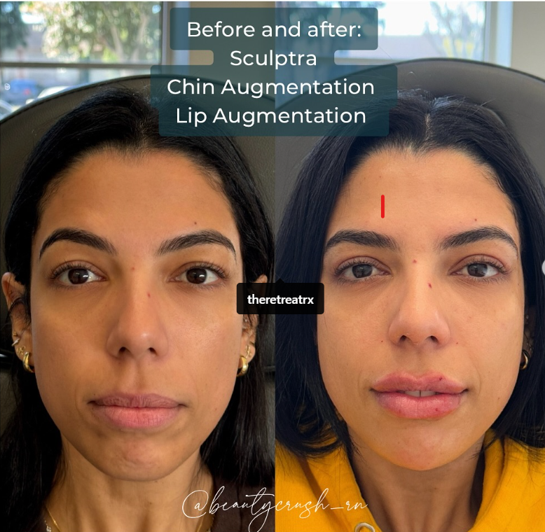 Sculptra Chin Lip Augmentation
