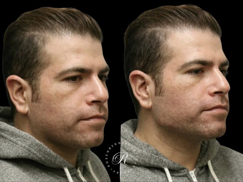 Non-surgical ChinJaw Augmentation RPS Before & After.zip - 8