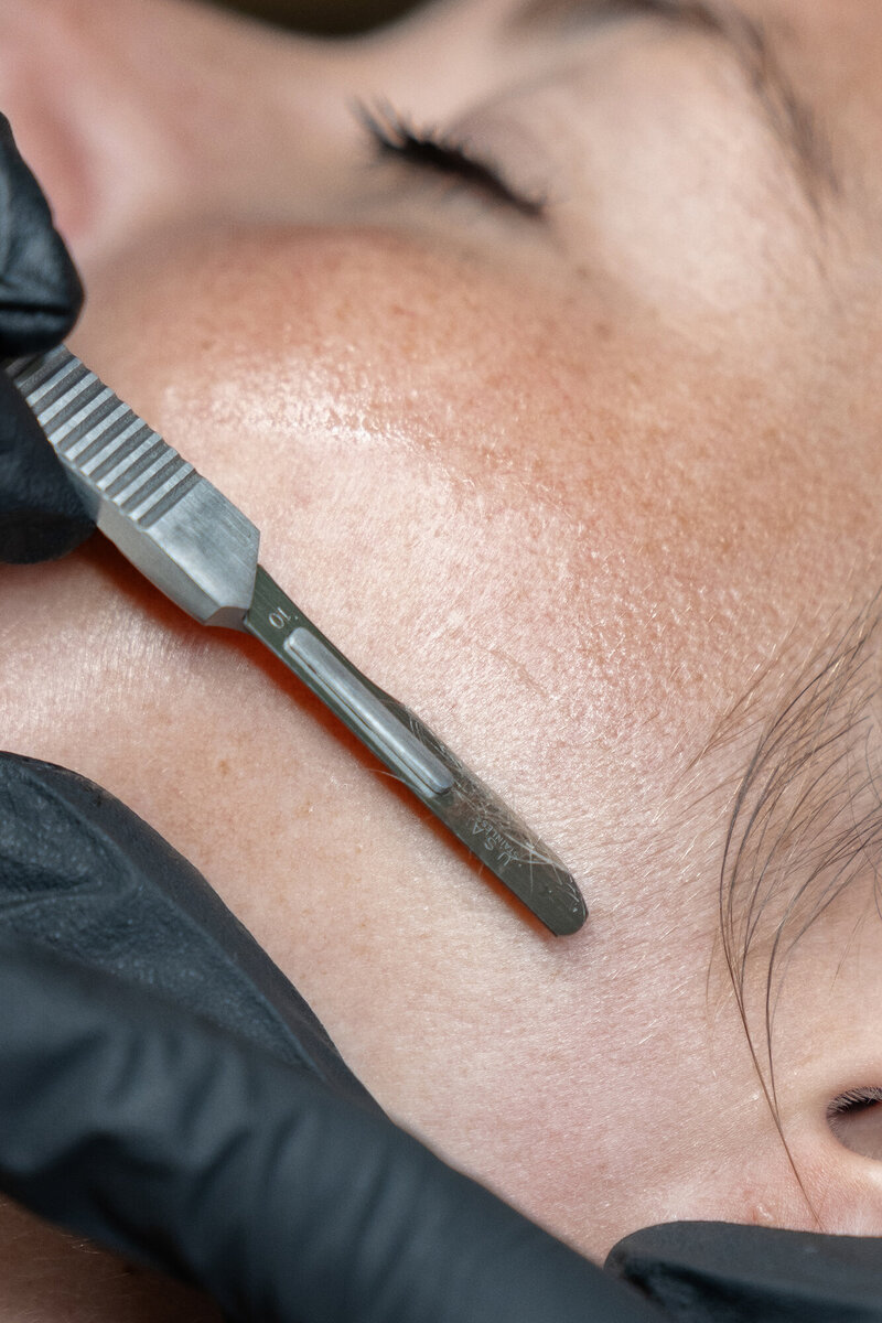 Close-up of dermaplaning treatment on a woman's face at a Charleston spa