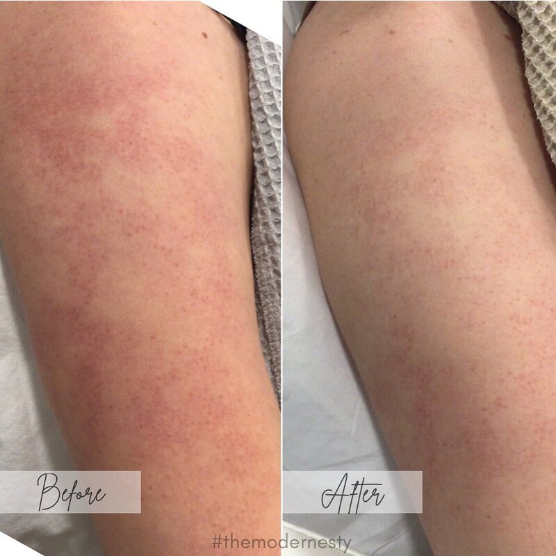 Keratosis Pilaris by Aerolase