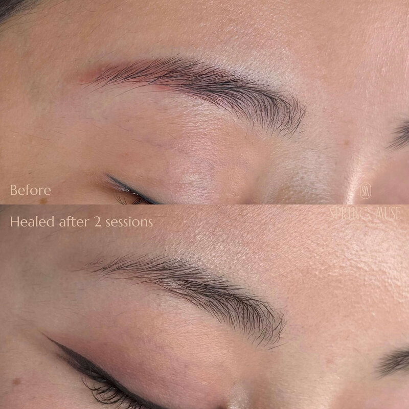 Red brows after PMU? We can remove them. NYC