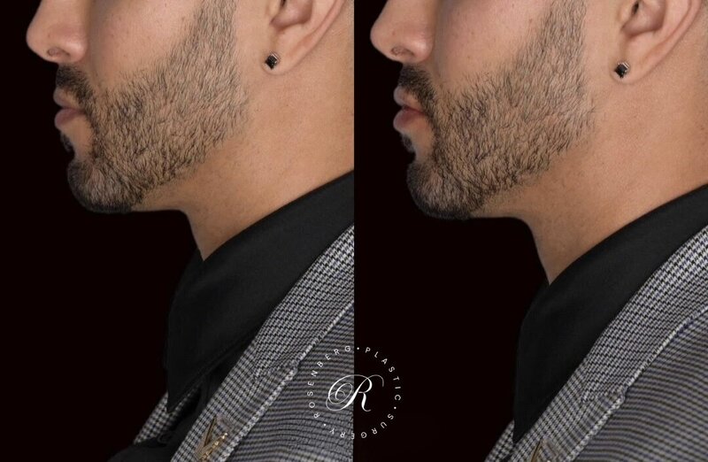 Non-surgical ChinJaw Augmentation RPS Before & After.zip - 24