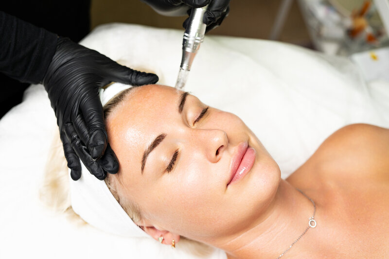 Microneedling session promoting skin rejuvenation at Gloss RVA
