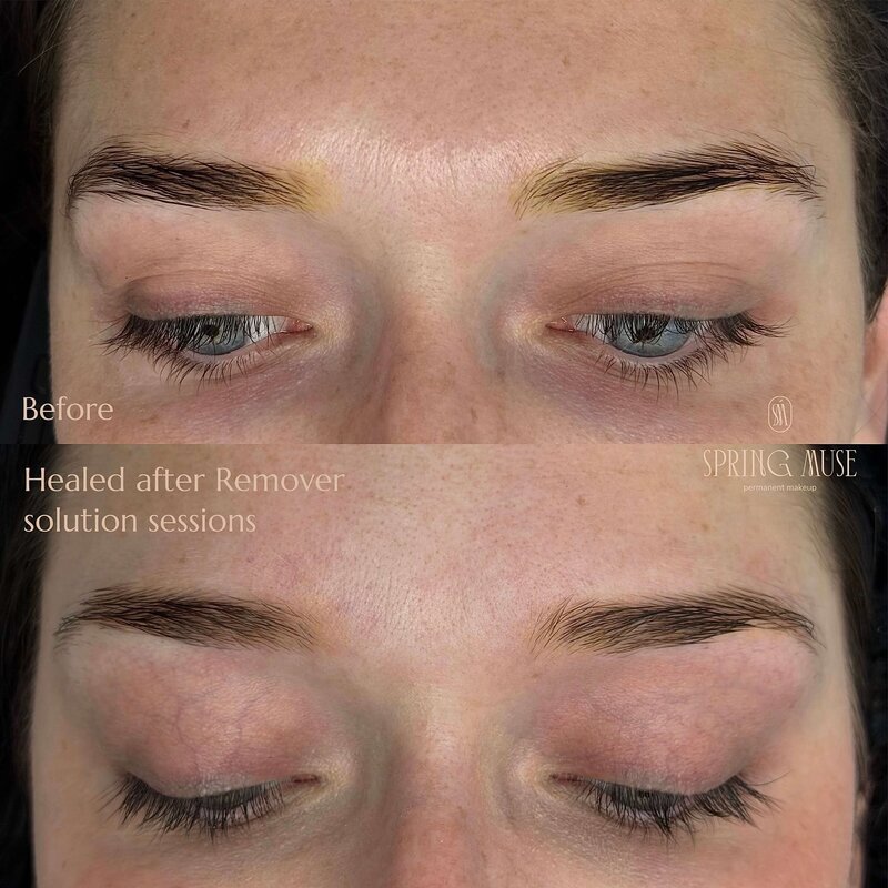 Yellow eyebrows removal NYC