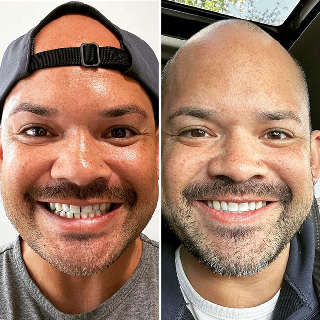 invisalign-before-after3