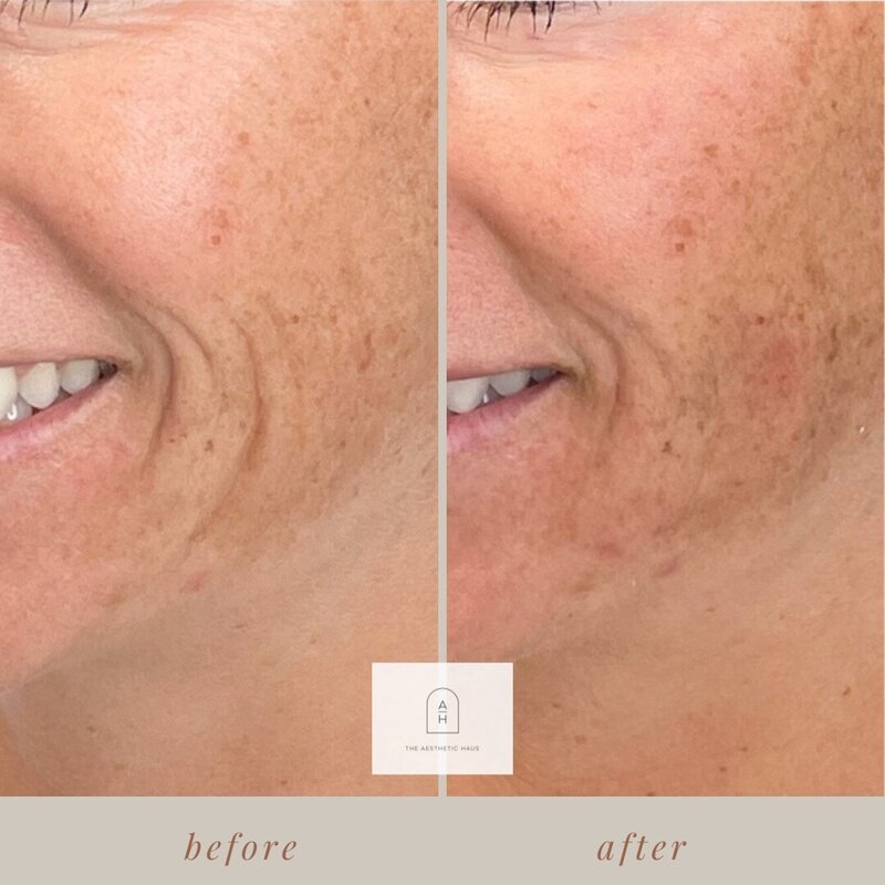 Juvederm Skinvive - Smile Lines 1