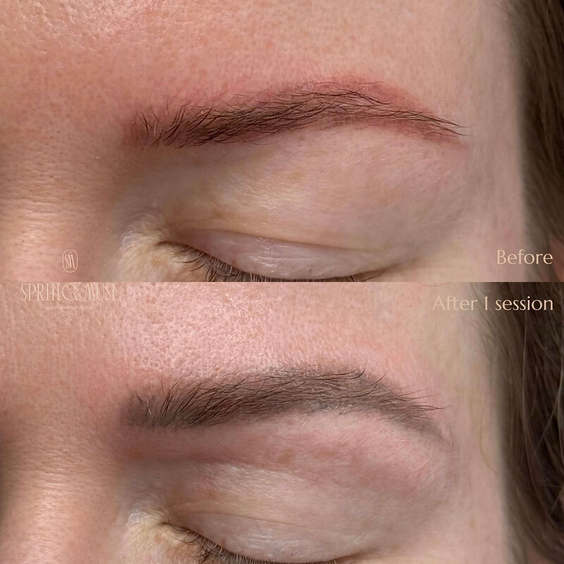 Laser Eyebrows Removal New York
