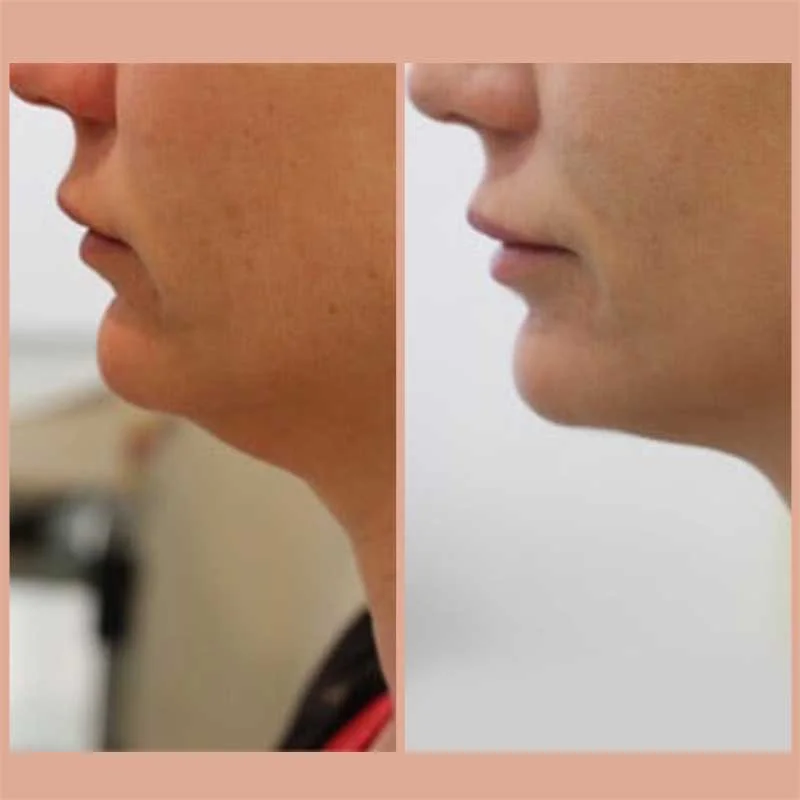 Before and after image of lipodissolve on chin
