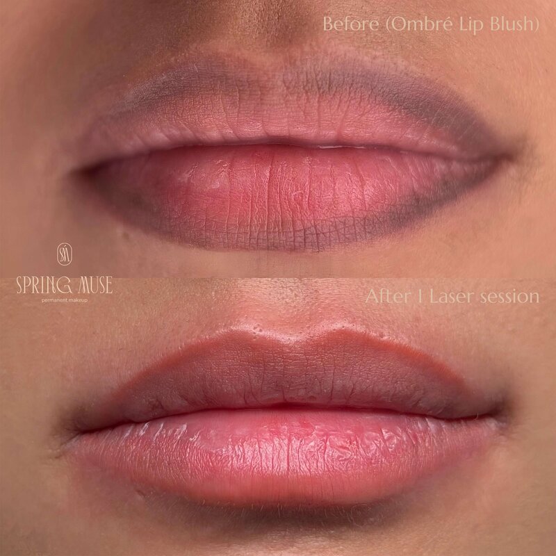 Laser Lip Blush Removal New York