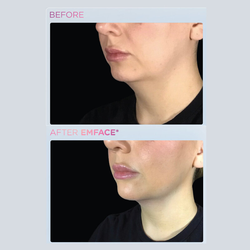 Emface before and after photo of chin and cheeks