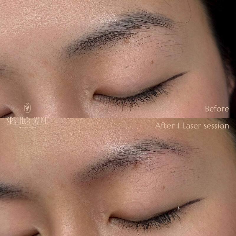 Laser Eyebrows Removal New York