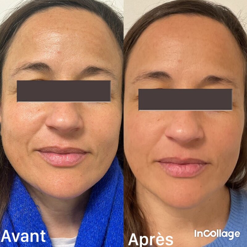 avant après du jetpeel