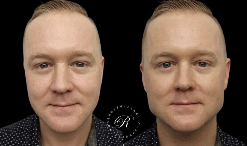 Non-surgical ChinJaw Augmentation RPS Before & After.zip - 13