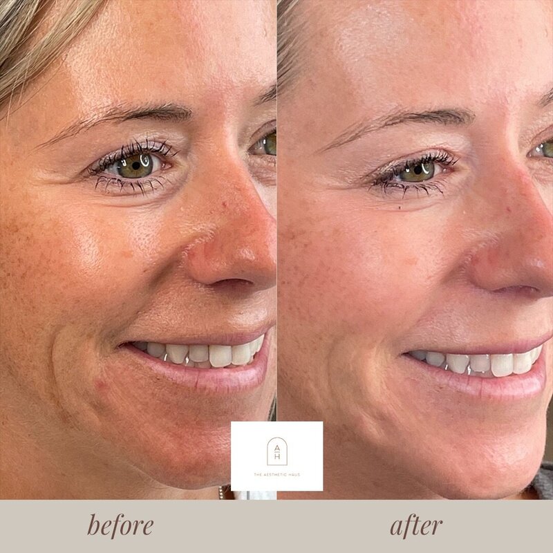 Skinvive Injections near me