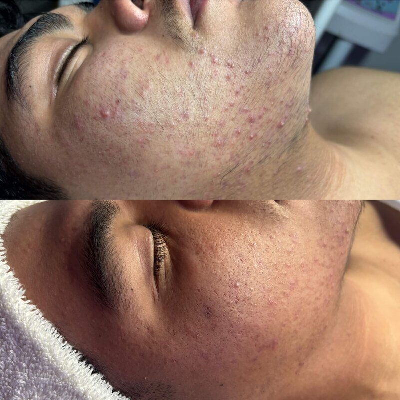 Acne Treatment Before & After