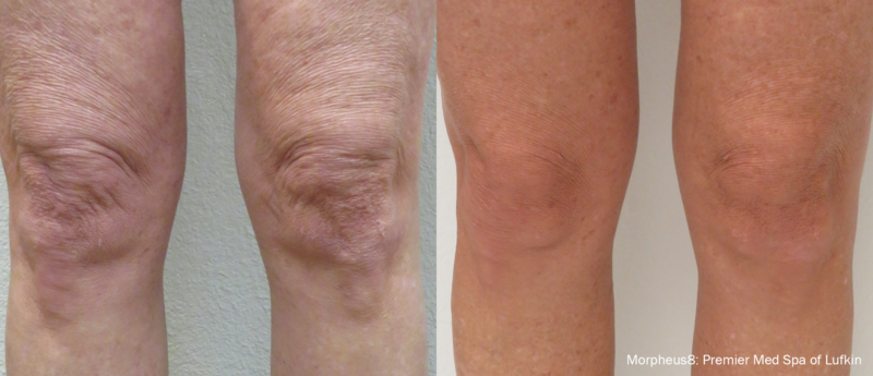 morpheus8-before-after-premier-med-spa-of-lufkin-preview-1
