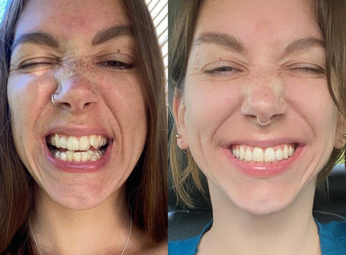 invisalign-before-after1