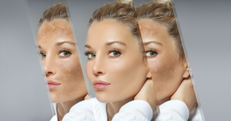 split panel image with before and after pictures of a woman who healed her melasma