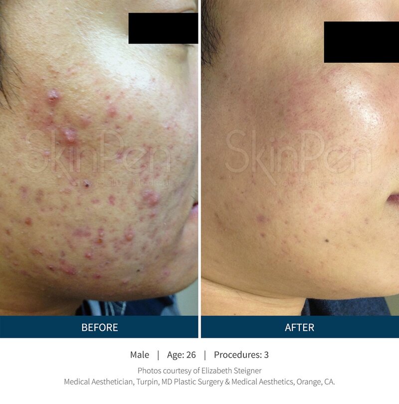 Microneedling before and after photo