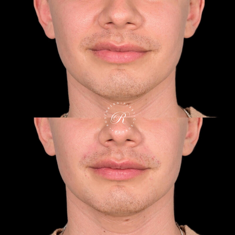 Non-surgical Lip Augmentation RPS Before & Afters.zip - 18