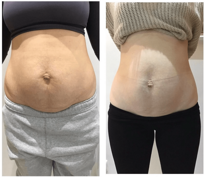 Venus-Freeze-before-and-after-on-tummy-belly (1)