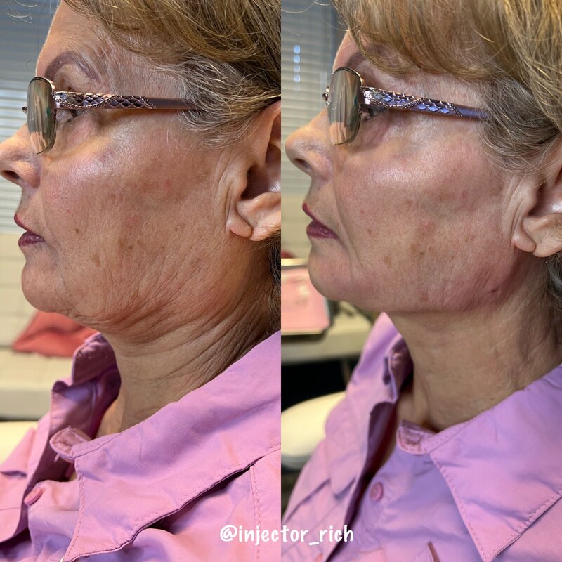 Client Results for services from Rich Medical Aesthetics in Midland, TX.