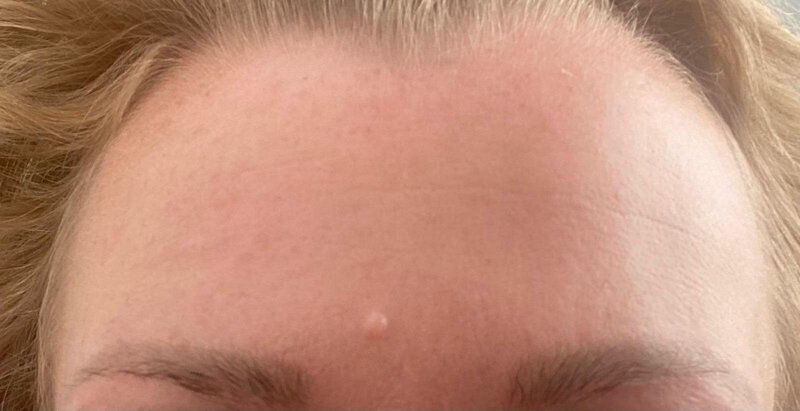 carbonpeel soins esthétique