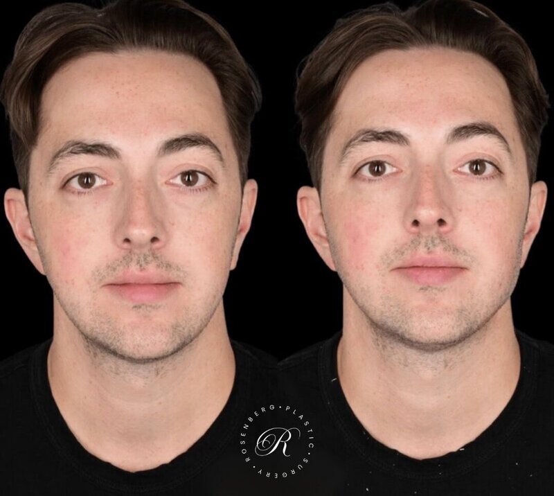 Non-surgical ChinJaw Augmentation RPS Before & After.zip - 30