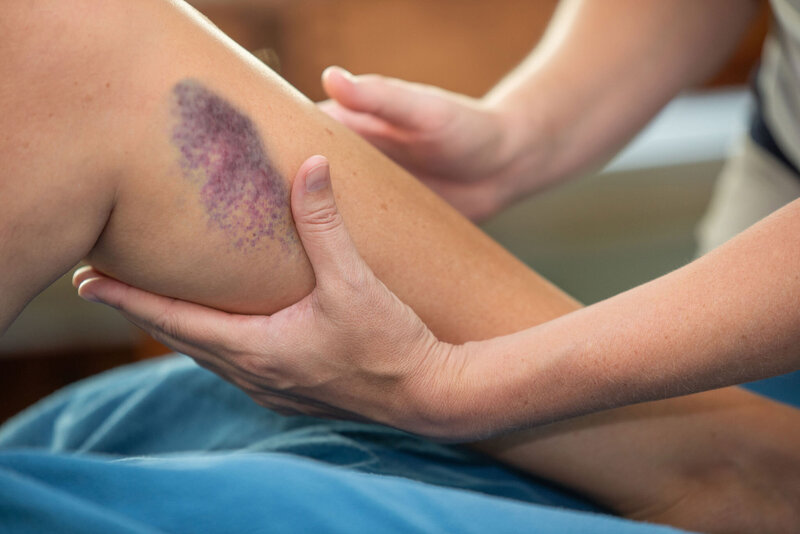 BNE_9817_BRUISE2