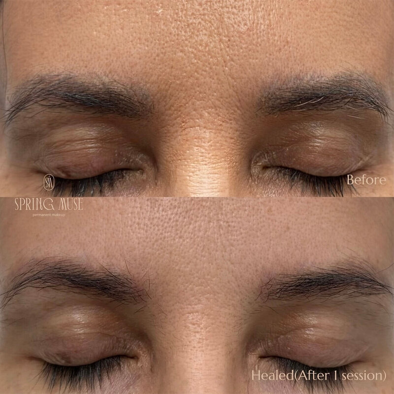 Laser microblading removal NYC