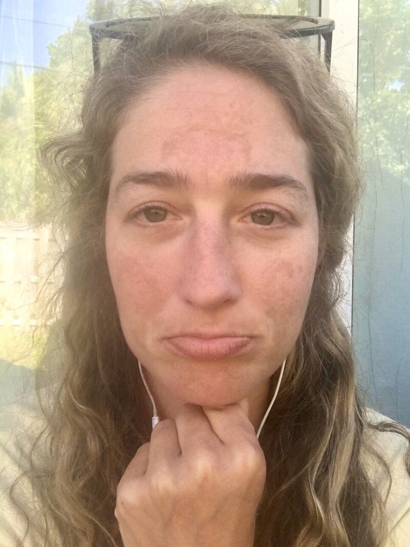 woman frowning because she has melasma