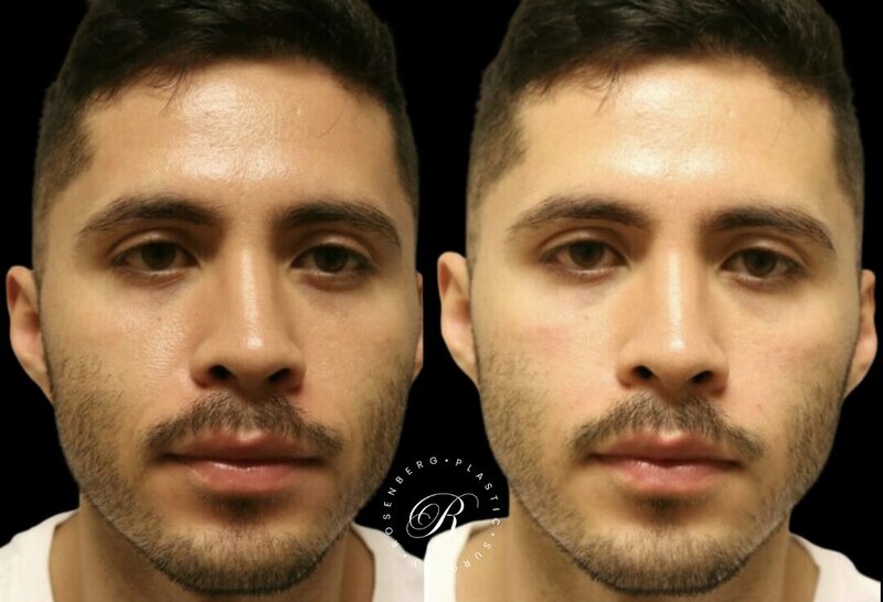 Non-surgical Cheek Augmentation RPS Before & After.zip - 1