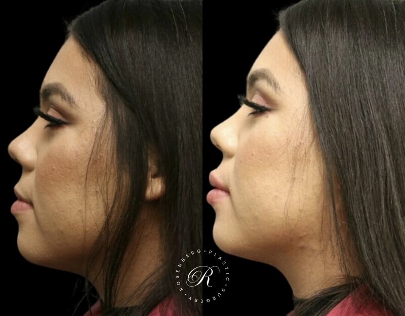 Non-surgical Lip Augmentation RPS Before & Afters.zip - 22