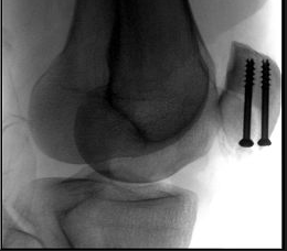 ORIF knee surgery repair screws