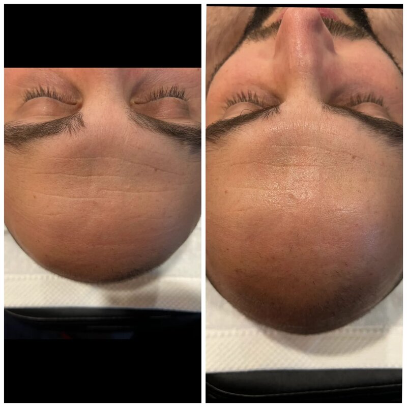 infirmière-esthétique-jet-peel-brignoles