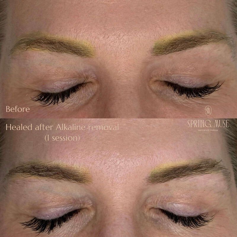 Yellow eyebrows removal NYC
