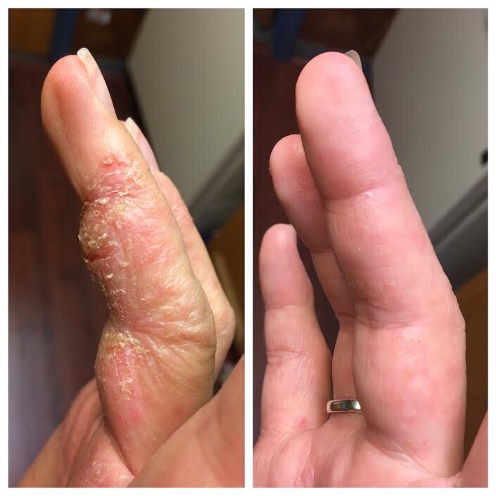 Psoriatic Arthritis