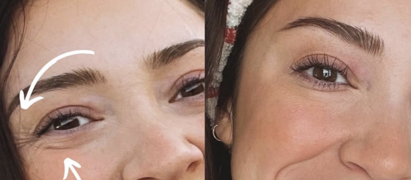 Smooth, youthful skin after Botox injections in Huntington Beach