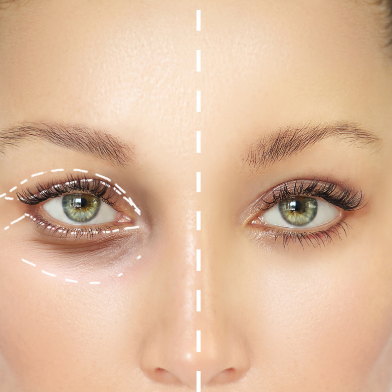 Image of woman's eyes with before and after of dark circles around eyes