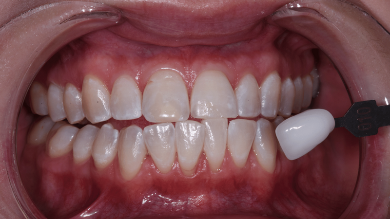 Example 1-After getting the Zoom Whitening treatment